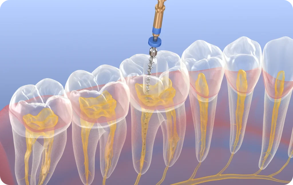 endodontie au Cabinet Dentaire du Pays de la Zorn
